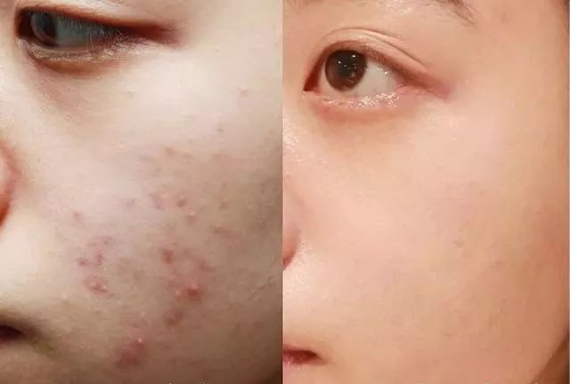 国货之光!60年专业研发的皮肤救急神器,一抹祛痘,抑菌,止痒